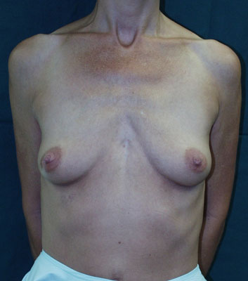 chirurgie apres augmentation mammaire 4a