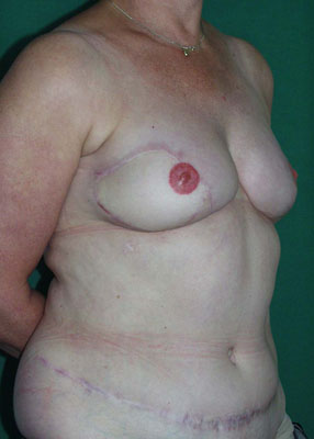 chirurgie apres reconstruction mammaire 2b