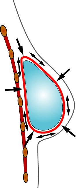 complication implants 1