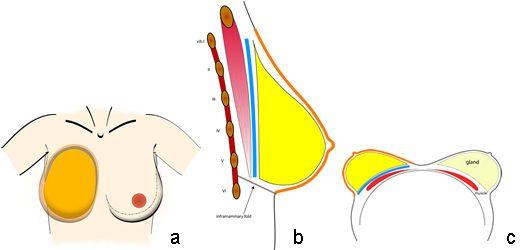 taille et position typiques de l'empreinte (bleu), du cône (jaune) et de l’enveloppe cutanée (orange ) du sein sur la paroi thoracique en vue frontale (a), sagittale (b), et en décubitus dorsal (c).