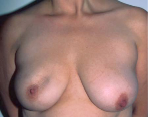 status après tumorectomie du quadrant supéro-interne du sein droit.
