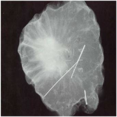 radiographie le la même tumeur après résection de la tumeur et du  harpon.