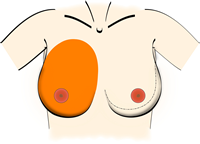 La plaque aréolo-mamelonnaire (PAM) 