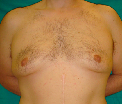 gynecomastia 1a