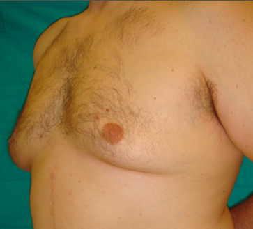 gynecomastia 1b