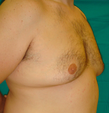 gynecomastia 2