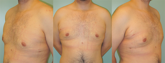 gynecomastia 4