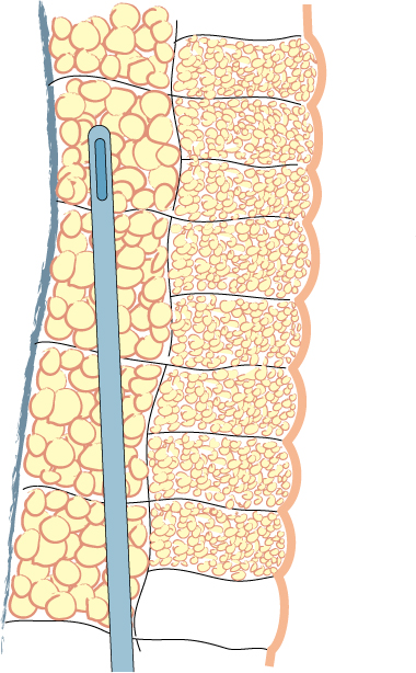 lipofilling in general 1