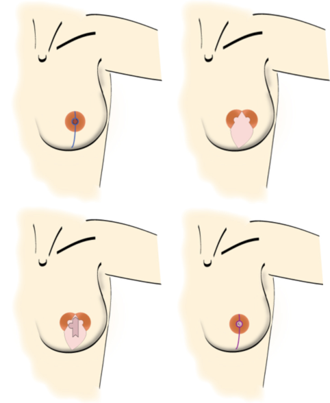Steps in an areola-sparing mastectomy