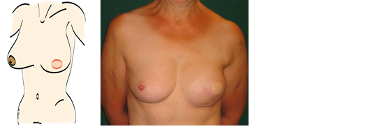 mastectomy et reconstruction