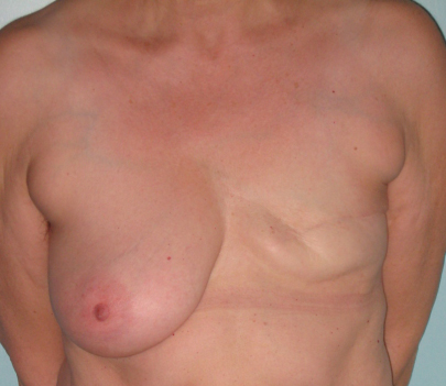 reconstruction mammaire 2