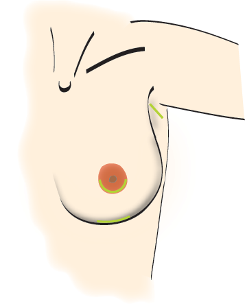 augmentation mammaire 1
