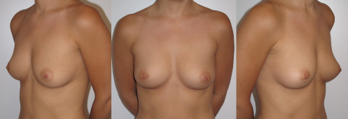 augmentation mammaire 10