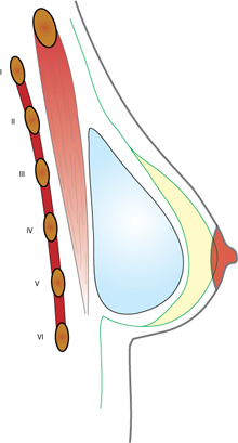 augmentation mammaire 2a
