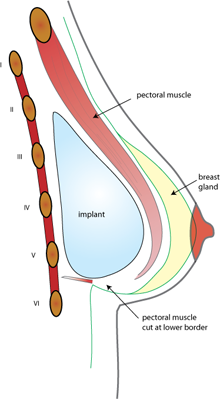 augmentation mammaire 2b