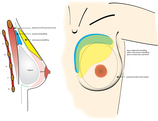 augmentation mammaire 3