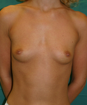 augmentation mammaire 6