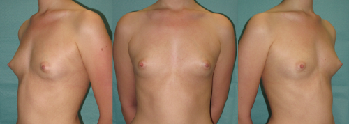 augmentation mammaire 8