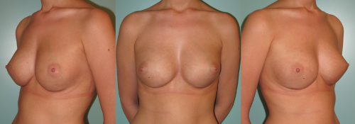 augmentation mammaire 9