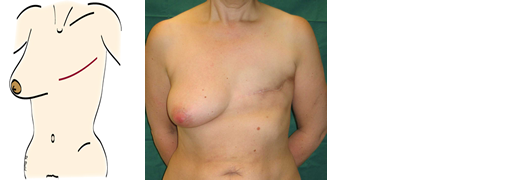 mastectomy