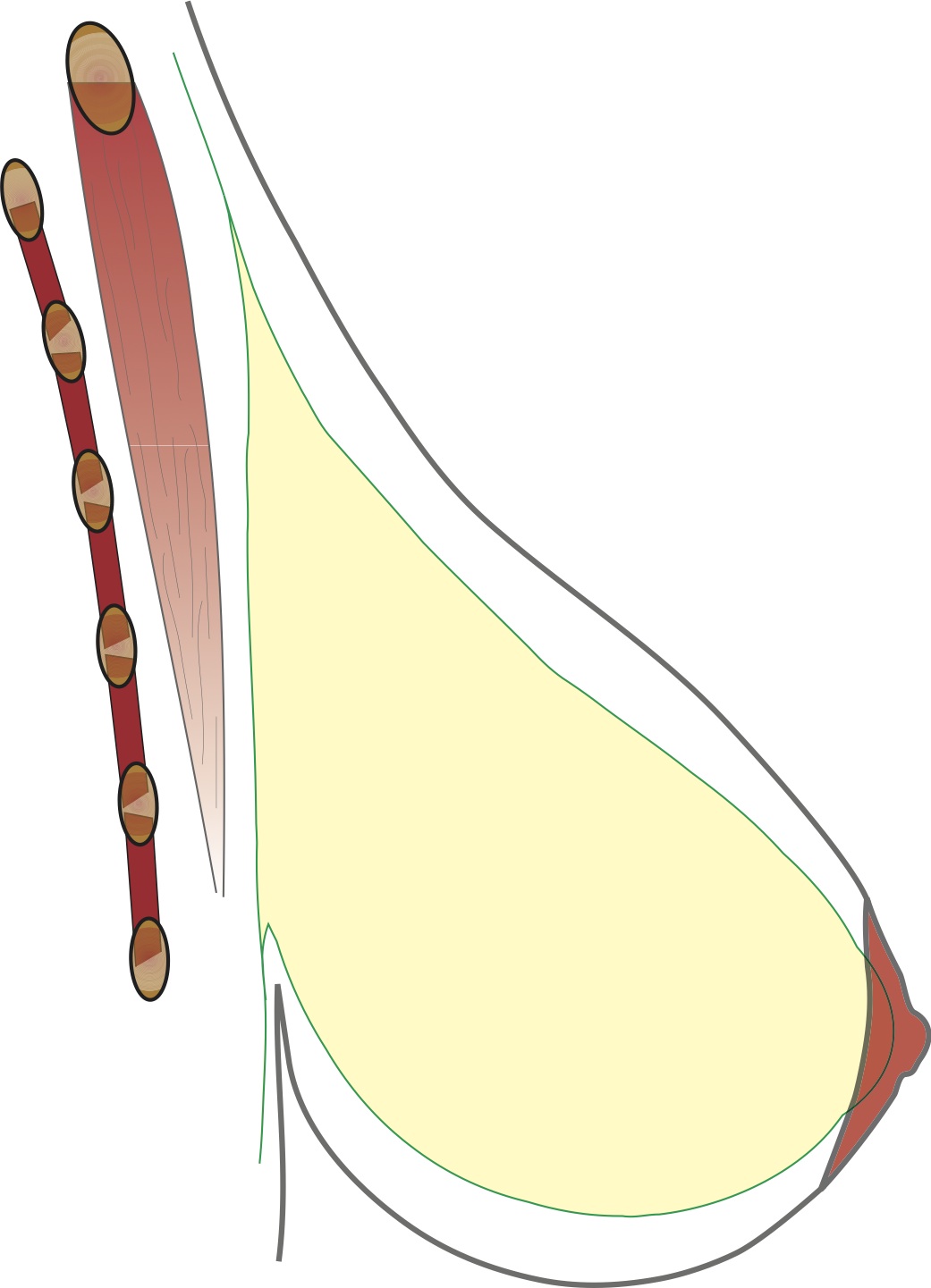 reduction mammaire 1c